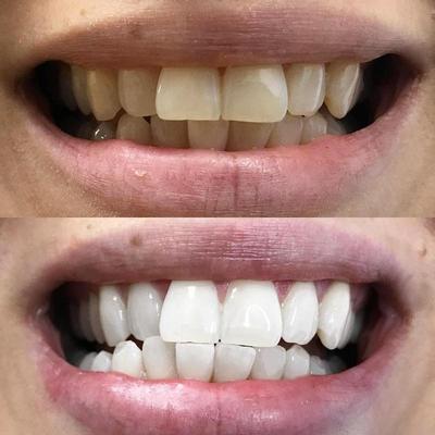 Tanden bleken voor witte tanden. De foto toont een voor en na foto van tanden na het bleken.