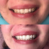 Diamond Smile resultaatervaring geactiveerde houtskool tandbleek strips