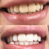Witte tanden door bleken van tanden