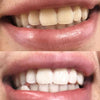 Ervaar Diamond Smile tanden bleken paars kleurcorrectieschuim - Voor-foto Na-foto van witte tanden