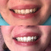 Tand Whitening Kleurcorrectie Schuim om tanden witter te maken