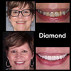 Resultaat Diamond Smile tandbleek kleurcorrectie foam - Voor-foto Na-foto van witte tanden