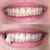 Witte tanden door tanden bleken. Foto's van een vrouw na het bleken van haar tanden.