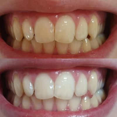 Witte en gele tanden. Witte tanden na het bleken met tand whitening gel. Tanden bleken met tand whitening.