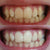 Witte en gele tanden. Witte tanden na het bleken met tand whitening gel. Tanden bleken met tand whitening.