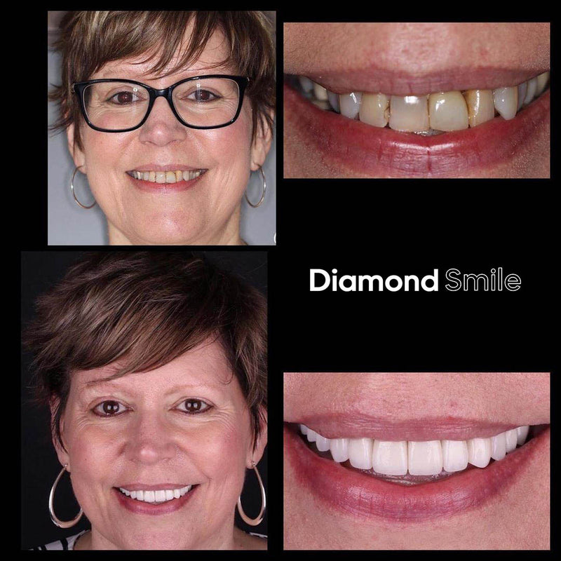 Diamond Smile tanden bleken ervaring - Vrouw met voor en na foto van witte tanden