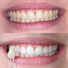 Voor en na het bleken van tanden met Bleaching Glow Stick van Diamond Smile