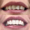 Witte Tanden met Tanden Blekende Pen - Tanden Bleken
