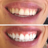 Whitening strips voor witte tanden
