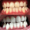 Tandenbleekschuim om tanden witter te maken