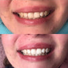 Tanden bleken met Diamond Tooth Whitening Gel
